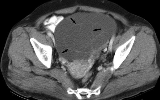 Fig. 3 70-year-old woman with unilateral ovarian metastasis from colon cancer. Contrast-enhanced CT scan shows cystic, oval ovarian masses with smooth margins.