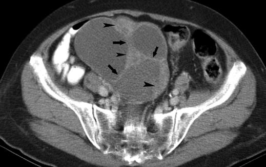Histopathologically, metastatic colorectal cancer often simulates primary adenocarcinoma of the ovary [4, 22 25].