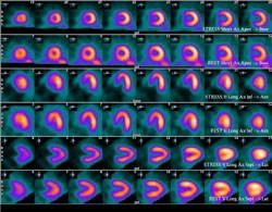 Example of Nuclear images of Cardiac sectors in a