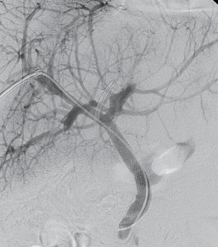Two patients showed long-term clinical success with patent stents and no symptoms at one year after the intervention.