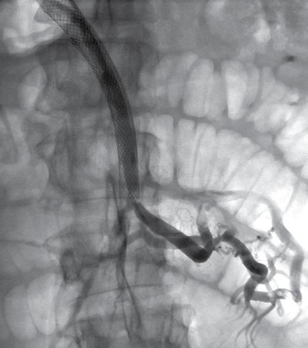 Patient number five returned for another recanalization and stenting after 14 months following the initial procedure.