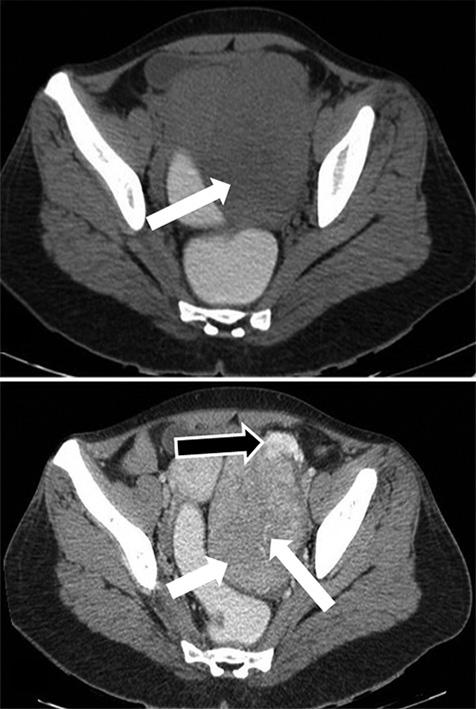 The lesion cuses displcement of uterus inferiorly nd towrd right side. Right dnex ppered unremrkle [Figure 3]. No evidence of prortic lymphdenopthy ws noted [Figure 3].