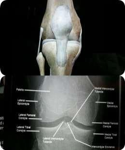 strong and acts as shock-absorber, its found between the vertebrae and the knee joint to resist the different mechanical forces without distortion Why symphysis pubis is fibrocartilage?