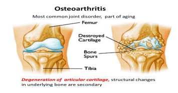 Clinical application: Osteoarthritis (degeneration of the joint): The articulating surfaces of long bones are covered by a layer of articular cartilage (hyaline), this articular cartilage is smooth