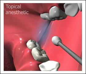 Unit 3: Techniques of Local Anesthesia Apply topical anesthetic to the target area.