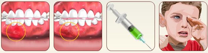 LOCAL ANESTHESIA IN PEDIATRIC DENTISTRY Unit 3: Techniques of Local Anesthesia (Refer fig. 22 to 25) (Fig.