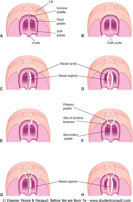 Malformations: Cleft Lip and Palate Incisive fossa separates anterior and posterior parts Anterior clefts unilateral (E) or bilateral (F) Complete vs.