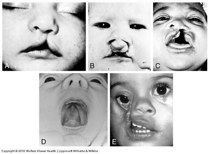 Malformations: Facial clefts Oblique (orbitofacial fissure) (E) Maxillary with lateral nasal