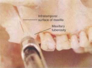 the occlusal plane Inward medially towardes the midline 45 degree to the occlusal plane Backward-45 degree