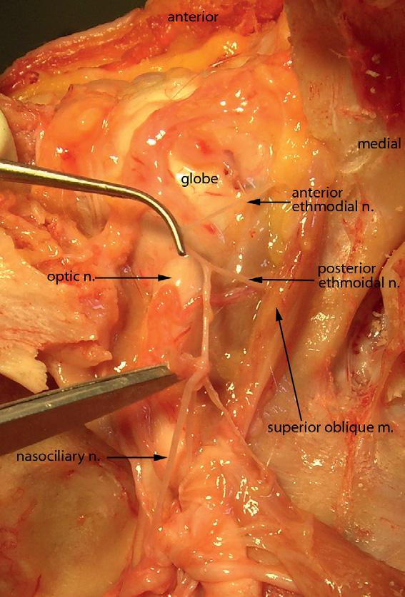 Cranial Nerves and Autonomic Innervation in the Orbit 541 Figure 7 A deep dissection of the orbit seen from the superior view.