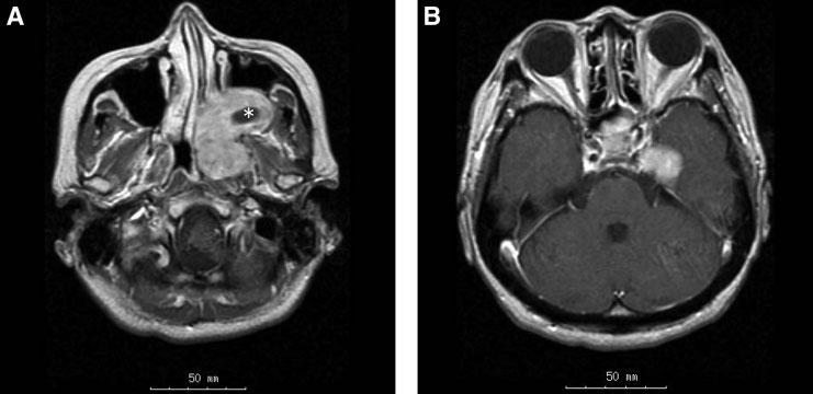 FIGURE 1. Preoperative T1-weighted gadolinium-enhanced MR images. (A) A homogeneously enhanced tumor occupies the retromaxillary space. There is a cystic component inside the tumor ().