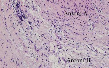 Histopathologic examination confirmed the diagnosis of benign schwannoma; the tumor was composed of a mixture of cellular areas (Antoni A) and looser myxoid areas (Antoni B) (Figure 3).