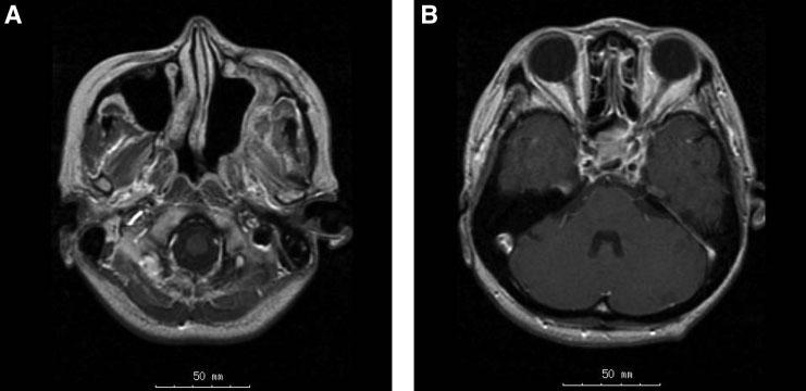FIGURE 5. Postoperative T1-weighted gadolinium-enhanced MR images at 1 month postoperative. (A) and (B) correspond to the preoperative images of Figures 1A and 1B, respectively.