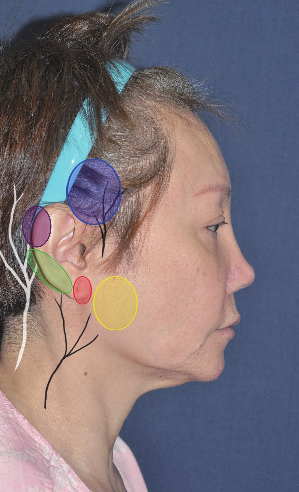 Lee JH et al. Preventing periauricular paresthesia Fig. 1. Sensory distribution of the periauricular area Fig. 2.
