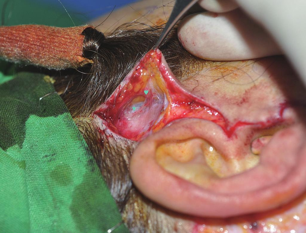 The auriculotemporal nerve emerges into the temporoparietal fascia and stays under the thin outer superficial fascia just below the subfollicular level.