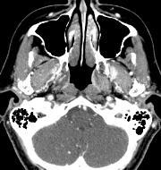 77-year old woman with recurrent