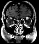 Imaging (Brain MR) allegedly normal.