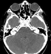 into branches-lacrimal, nasociliary, frontal