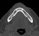 mandibular nerve (V 3 )