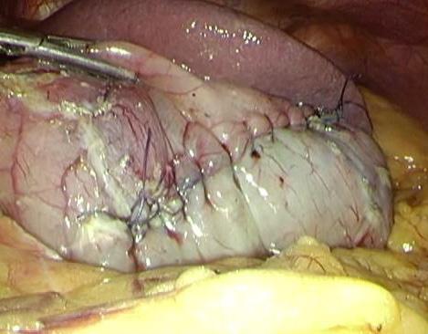 demarcation line; (B) ICG was injected to the gastric