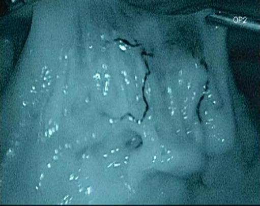 inversion of the primary lesion; (J) endoscopic
