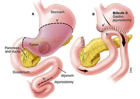 Subtotal Gastrectomy with