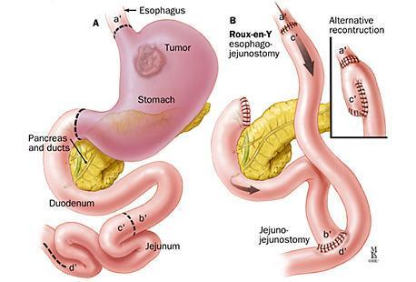 Total Gastrectomy with