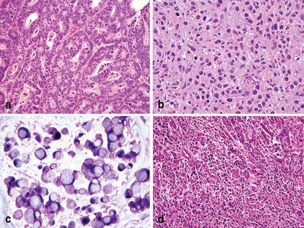 Histology WHO Classification-Carcinoma Intestinal Tubular Papillary