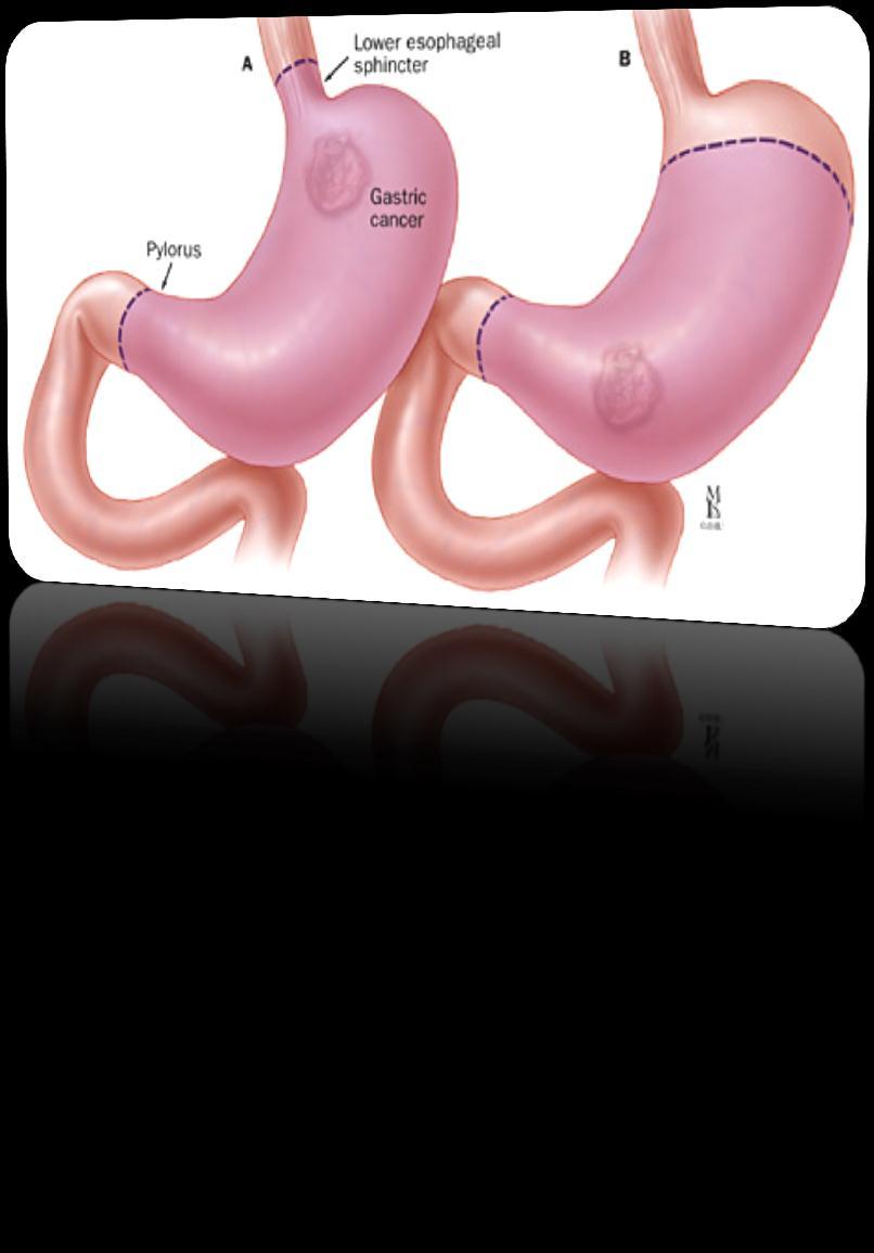 Gastric Cancer-surgical