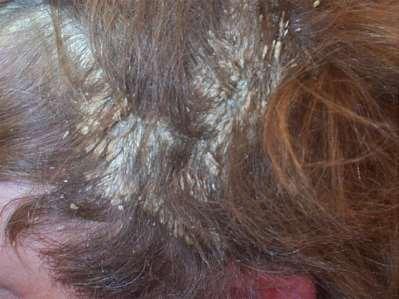 SCALP PSORIASIS Mild - scalp will be dry and scaly Mod/severe - scalp will also