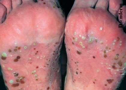 PALMOPLANTAR PSORIASIS Palms and soles are inflammed and scaly with yellow sterile pustules Pustules dry