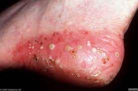 TREATMENTS FOR PALMOPLANTAR PSORIASIS Emollients Topical