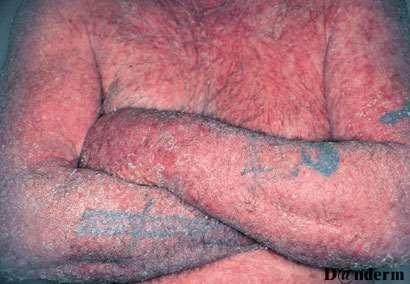 ERYTHRODERMIC PSORIASIS Entire skin surface is inflammed Derm.