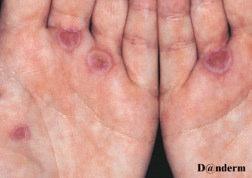 TEN / SJS - Differential diagnoses Erythema Multiforme - self limiting reaction triggered by infections e.g. HSV.
