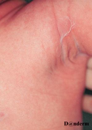 Staphylococcal scalded skin syndrome (SSSS) - a localised infection with a toxigenic strain of S.