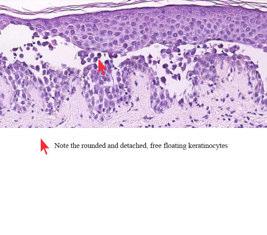 Pemphigus Vulgaris - treatment Confirm diagnosis with skin biopsy (including direct