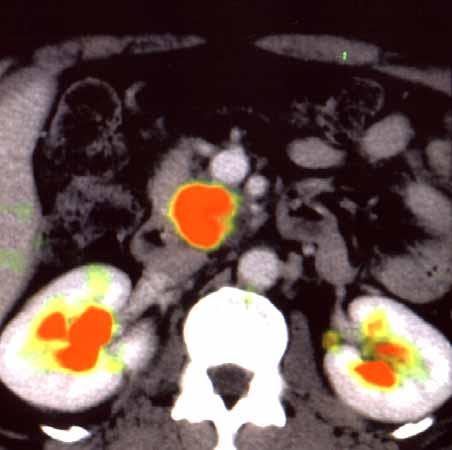 Adenocarcinoma Pancreas: CT and