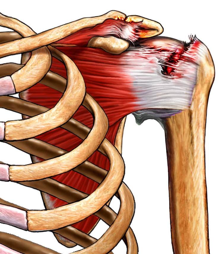 ROTATOR CUFF INJURY Rotator cuff injury may occur gradually from aging, repetitive stress, or injury to the shoulder while falling.