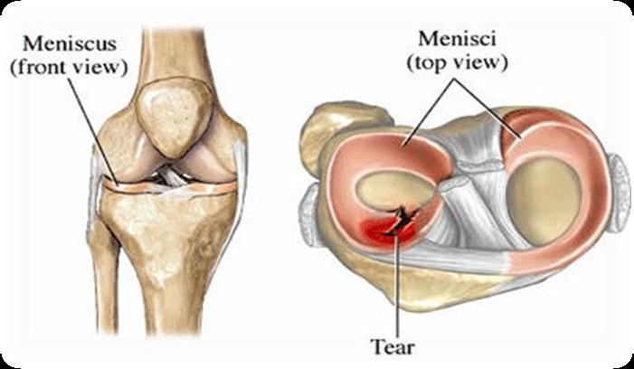Pain is elicited by flexion, internal rotation, and then knee extension.