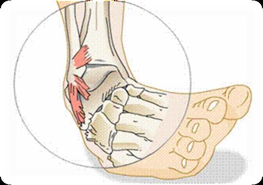 SOFT-TISSUE INJURIES A sprain is an injury to