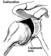 SUBLUXATION Subluxation is a partial or incomplete displacement of the joint surface. Manifestations are similar to a dislocation but are less severe.