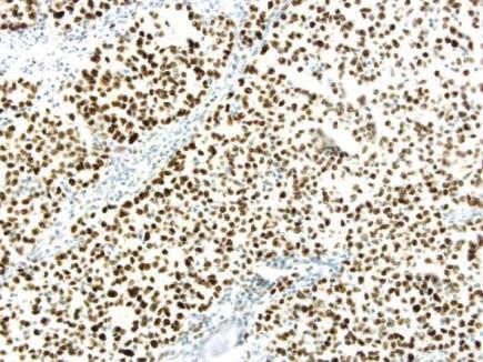 Tumor tissue IHC staining from Patient