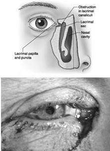 Papilledema Eyelid margin Eyelid lacerations Requires experienced closure to avoid notching Eyelid