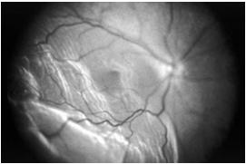 the lacrimal puncta and medial canthus Requires OR, silicone stenting Retina separates from back of eye