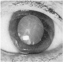 Acute eye conditions Flush all chemical exposures with at least 2L Acute glaucoma presents with nausea Papilledema is optic disk swelling secondary to increased intracranial pressure How