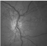 lens Usually age-related Causes glare problems and blurred vision Only treatment is surgery (replacement) Diabetic retinopathy Vasculopathy Clinically, yellow and red spots Hemorrhages,