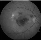 neovascularization Most of severe vision loss Glaucoma Damage to optic nerve Large cup-to-disk ratio