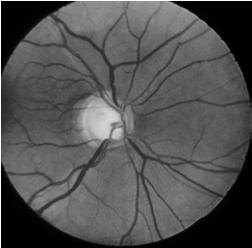Glaucoma Damage to optic nerve The P s Painless Permanent Progressive Preventable Glaucoma Chronic