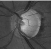 toward patient Identify a retinal vessel Dial counterclockwise to bring vessel into