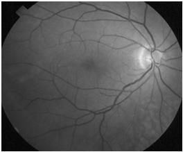 reflections Exam - funduscopic Red reflex Disk Vessels Background Macula Periphery Trace